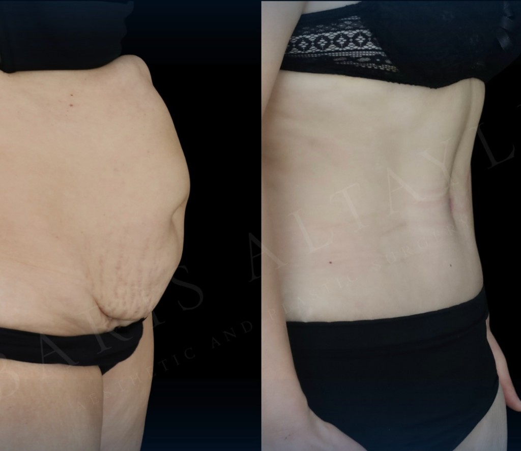 Abdominoplasty