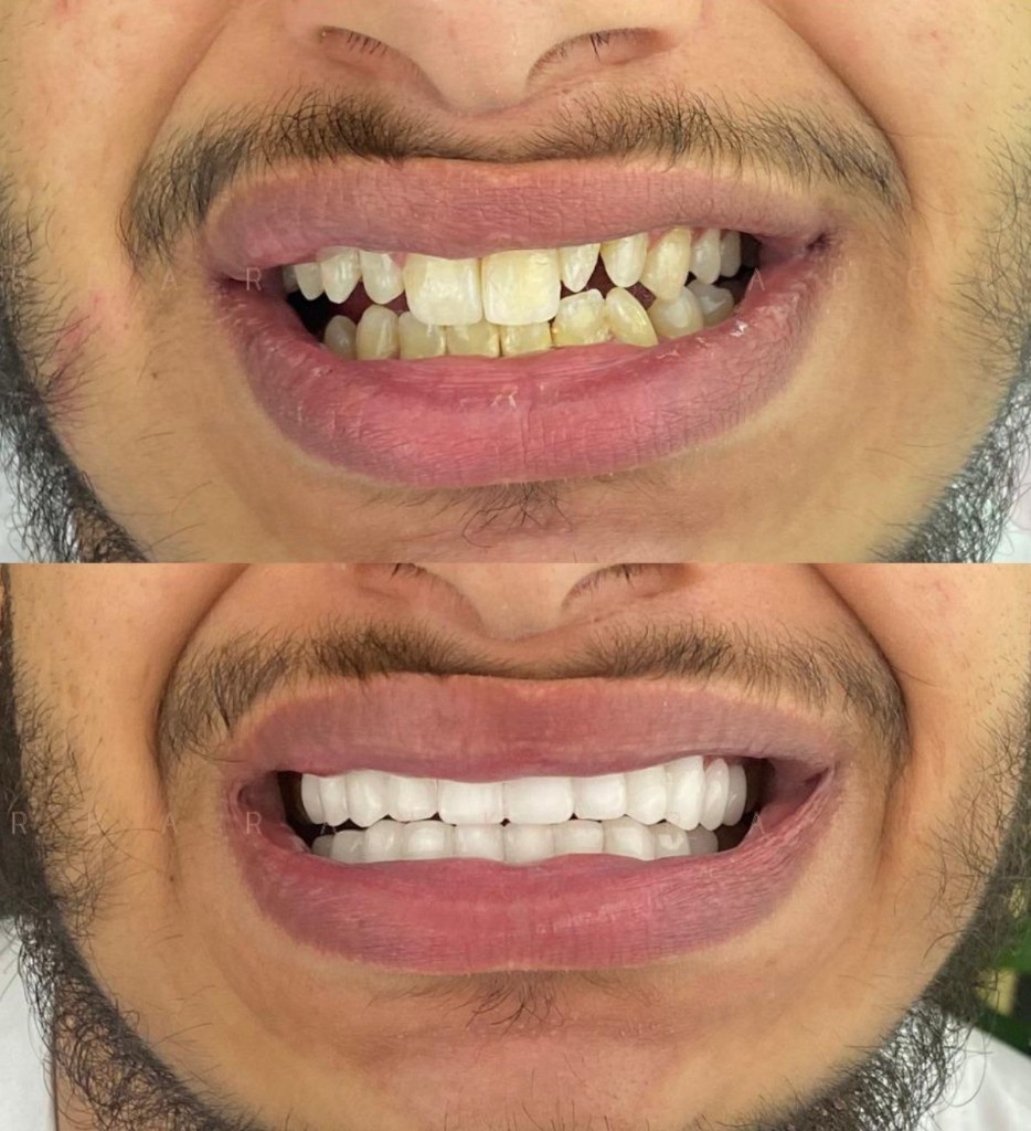 Male veneer before and after, individual results vary