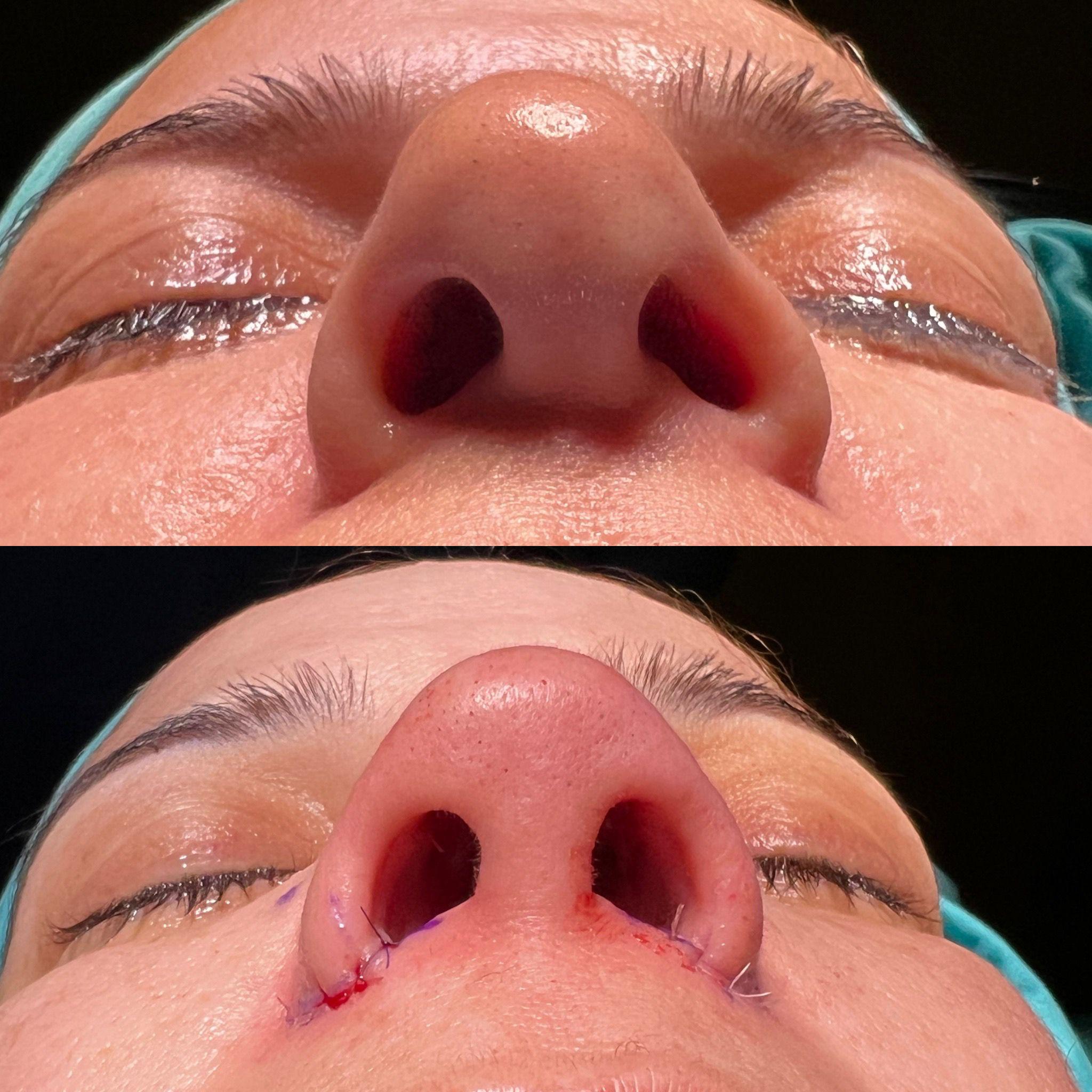 Identity-respecting rhinoplasty